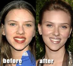 Image result for nose plastic surgery