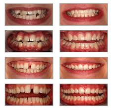 Image result for ‫لامینیت دندان‬‎
