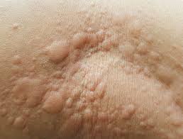 Nổi mề đay - Tìm nguyên nhân và cách điều trị hiệu quả
