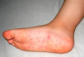 Znalezione obrazy dla zapytania coxsackie wirus