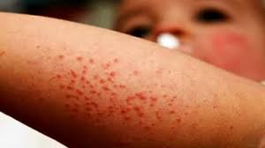 Trend Google: morbillo