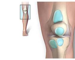 Imagen de Bursitis de rodilla