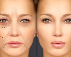 Before and after images of dermal fillers
