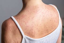 CDC Issues Urgent Warning as Measles Cases Surge Ahead of Summer Travel