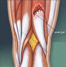 الإصابات الداخلية للركبة في ألعاب القوى Images?q=tbn:ANd9GcRIOtOpJERutNjre6D5uOfaxgK9M1FbtiNLLUKUuepL0PNbwl4Mfg