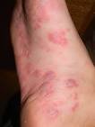 Dermatologic Manifestations of Enteroviral Infections: Background