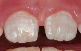 Image result for fluorosis