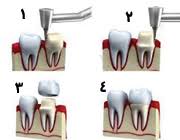 Image result for ‫روکش دندان‬‎