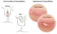 Symptoms of Type Genital Herpes M