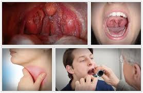 Image result for tonsil stones
