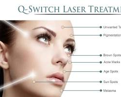 Image of Q switch laser pigmentation problems