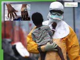 World Health News LIVE Updates: New Mpox Variant Wrecking Havoc In UK To Deadly Measles Sweeping Through London - Today's News Highlight
