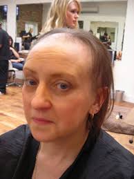 Helen Hall before Bald: Helen Hall before treatment. Helen, from Mansfield Woodhouse, near Nottingham, had already been suffering from TTM, as it&#39;s known, ... - Helen-Hall-before