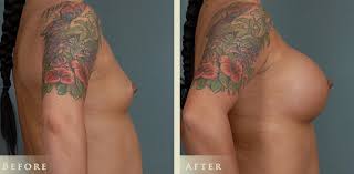 Image result for silicone implants