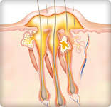 Image result for carbuncle