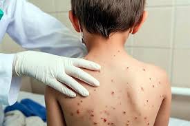 Sarampión En Chiapas