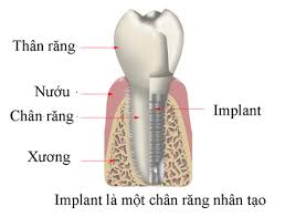 Kết quả hình ảnh cho làm răng implant o dau tot nhat