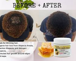 study on MSM showing increased hair growth in people with alopecia areata