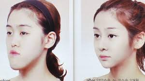 Image result for jaw surgery