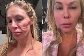 Brandi Glanville's Health Struggles: From Facial Parasite to Chemical Burns