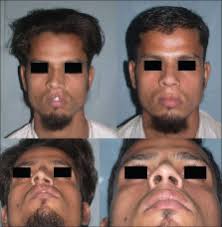 Authors: Uday Bhat, Bharat Patel. Source: PMC ID: 2825123. Journal: Indian Journal of Plastic Surgery : Official Publication of the Association of Plastic ... - large