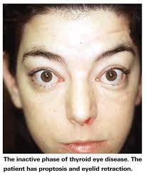 A 2009 report by Perry Rosenthal, MD, and colleagues described patients who have corneal pain suggestive of dry eye, with no clinical signs.2 The authors ... - 1_14694_2