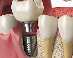 ایمپلنت دندان