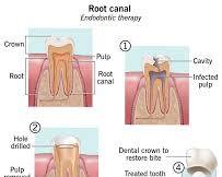 Image of Root Canal Treatment