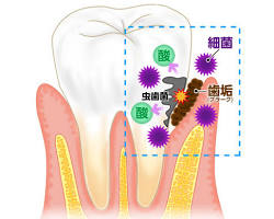 口腔内 細菌 歯垢