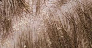 Image result for How to Prevent and Treat Dandruff?