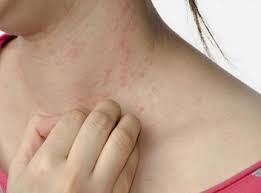 Resultado de imagem para Psoriase