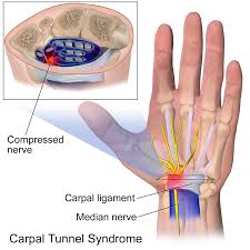 Image result for carpal compression test