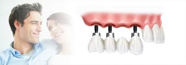 Kết quả hình ảnh cho LÀM RĂNG IMPLANT Ở ĐÂU TỐT