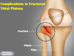Image result for tibial plateau fracture