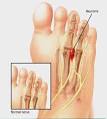 Morton s neuroma - Mayo Clinic