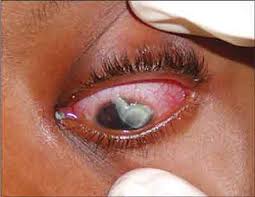Résultat de recherche d'images pour "eye infection"