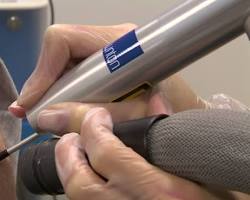 Image of Q switch laser tattoo removal