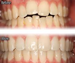 Image result for invisalign images before after