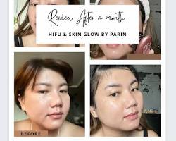 Hình ảnh về Before and after using Parin Mini HIFU