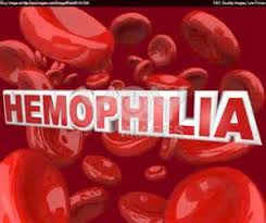 Image result for hemophilia patients