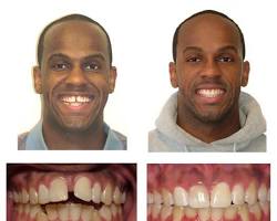 Image de Avantaprès un traitement orthodontique