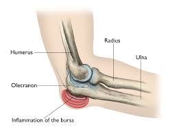 Image of elbow bursitis
