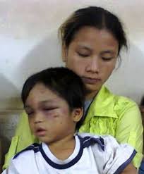 Bé 3 tuổi bị tra tấn: Tấn bi kịch truyền kiếp - 1. Cháu Đức với thương tích đầy người, 2 mắt tím bầm lim dim ngủ trong tay mẹ - 1383693943-7