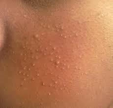 Image result for jenis jerawat