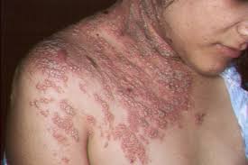 Image result for "Herpes Zoster"