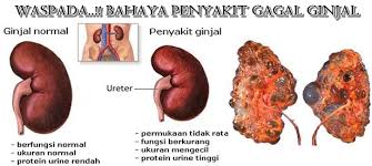 Hasil gambar untuk apa yang menyebabkan seseorang mengalami ginjal