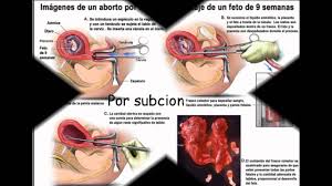 Resultado de imagen para aborto