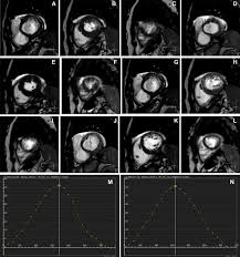 Representative images of participants with difficulty with breath holding and arrhythmia