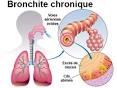 Bronchite chronique definition