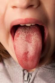 Image result for oral thrush